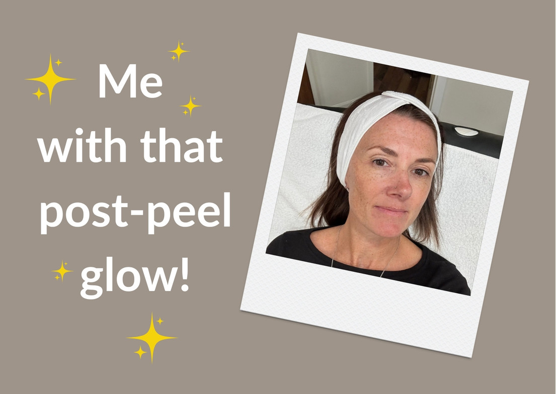 Post-Peel 
